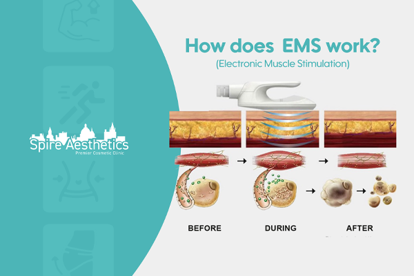 EMS treatment for post pregnancy weight loss treatment Tong