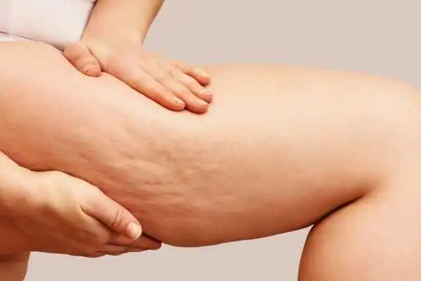 Image of woman showing leg with cellulite Tong