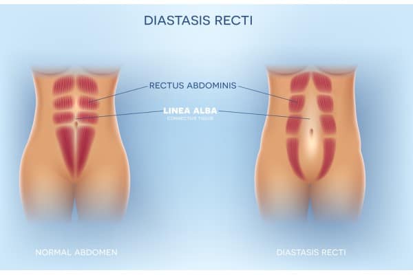 What Non-Surgical Options Are Available for Diastasis Recti Tong?