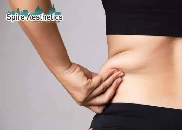 Image of woman pinching fat on their hips Tong. Fat Freezing treatment