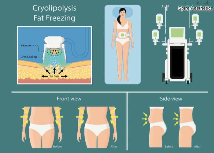 Image of diet and fat freezing combined for best results for Spire Aesthetics Tong