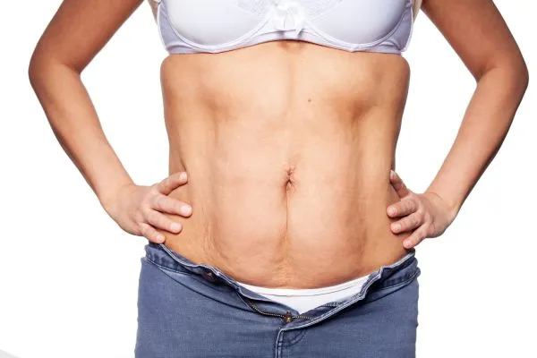 sagging skin on woman's stomach after weight loss injections Tong