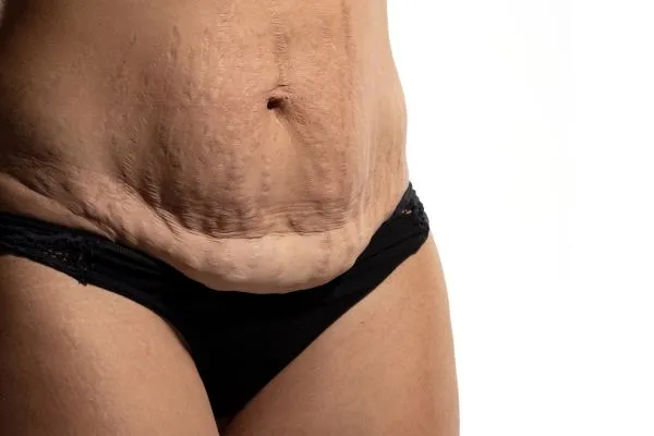 Image of womans stomach after weight loss injections Tong showing saggy skin