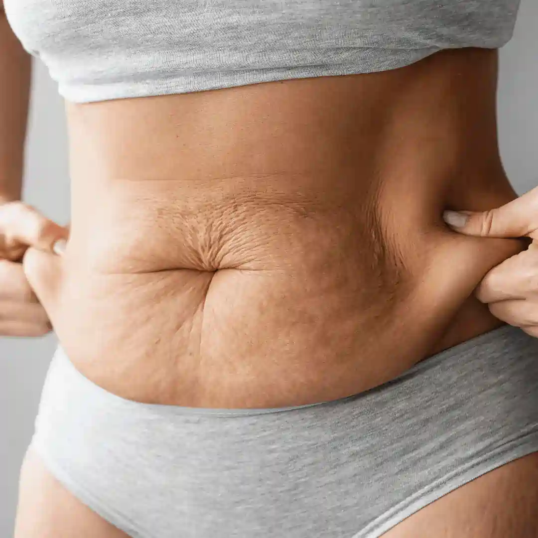 Is It Normal to Have Loose Skin After Pregnancy Tong?